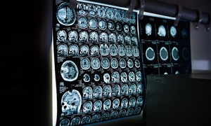 Wstrzykiwane implanty otwierają nowe możliwości leczenia neurologicznego
