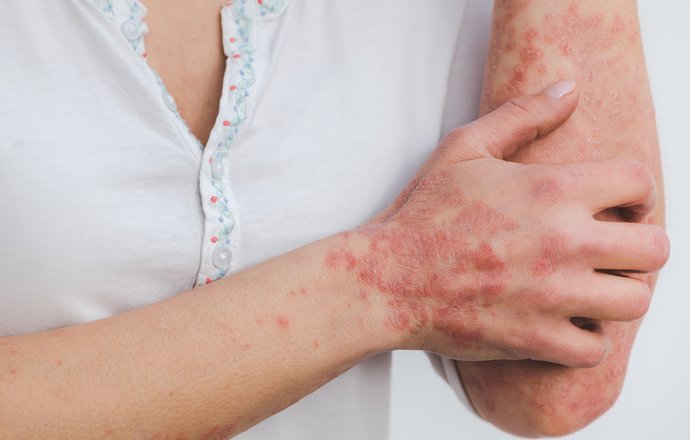 Suplementacja w dermatozach skórnych – AZS, ŁZS i łuszczycy